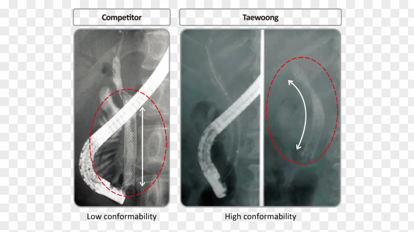 Tortuous Stenting Biliary Tract Bile Duct Self-expandable Metallic Stent Radiology PNG