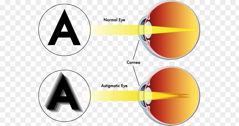 Astigmatism Headaches Near-sightedness Eye Far-sightedness Visual Perception PNG