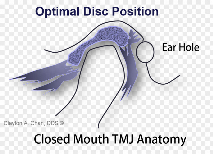 Temporomandibular Joint Dysfunction Syndrome Occlusion Disease PNG