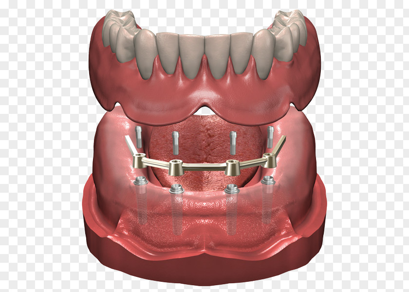 Implant Dentures Dental Prosthesis Dentist PNG