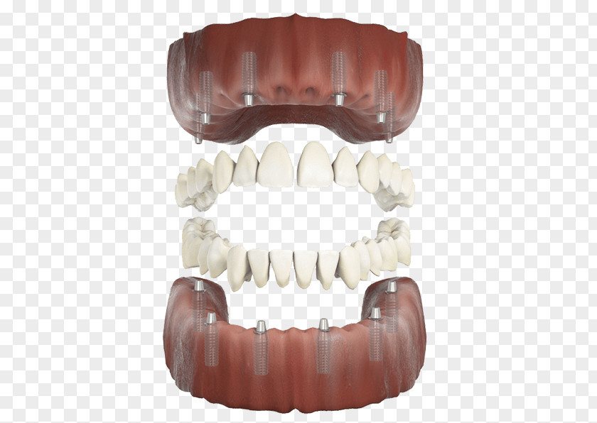 Tooth Implant Human PNG
