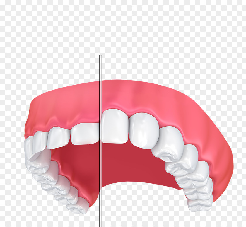 Comfort Anxious Patients Gums Gum Lift Dentistry Tooth Gummy Smile PNG