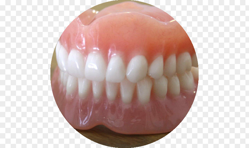 Crown Dentures Prosthesis Dentistry Dental Implant Tooth PNG