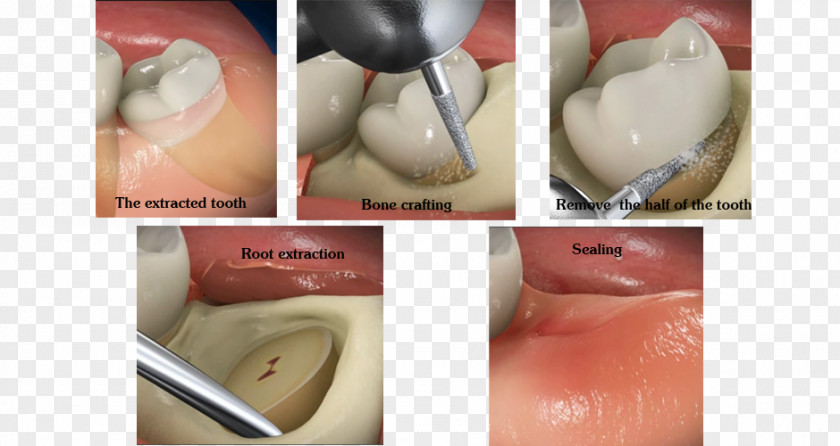 Wisdom Tooth Dental Surgery Dentistry PNG