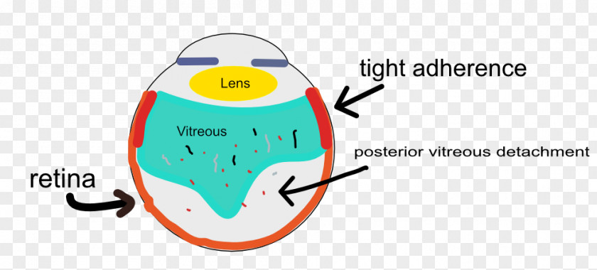 Eye Posterior Vitreous Detachment Floater Body Retina Photopsia PNG