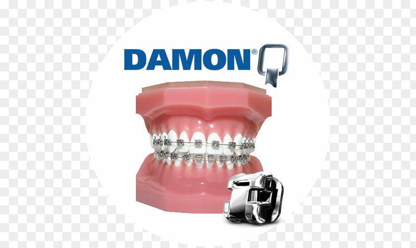 Selfligating Bracket Damon System Dental Braces Orthodontics Self-ligating Dentistry PNG