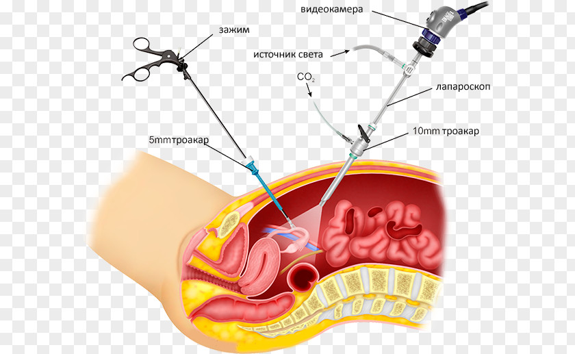 Macau Centre For Disease Control And Prevention Laparoscopic Hysterectomy Laparoscopy Surgery Gynaecology Surgeon PNG