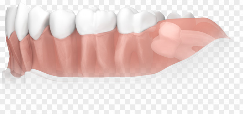 Tooth Apicoectomy Dental Surgery Dentistry PNG