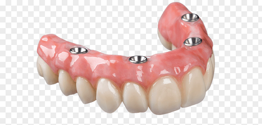Bridge Dental Implant Dentures Removable Partial Denture Prosthesis Dentistry PNG