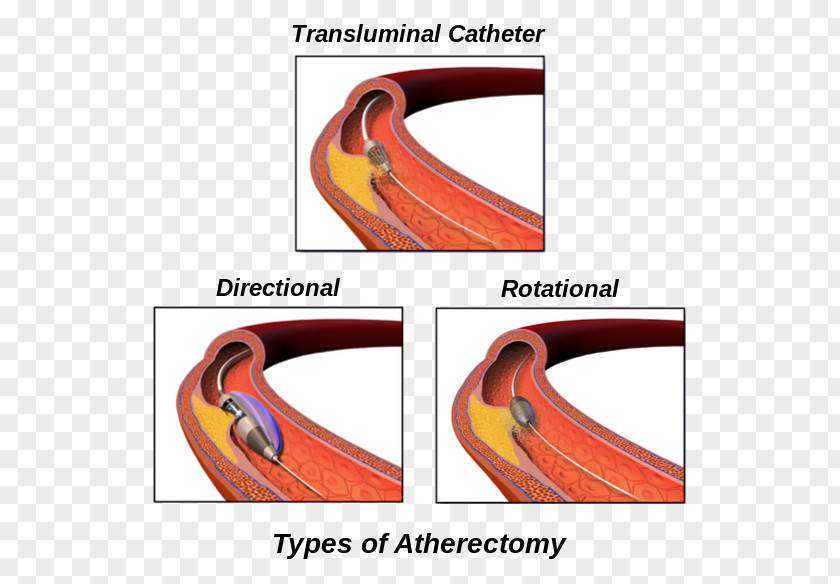 Vascular Bypass Atherectomy Peripheral Artery Disease Surgery Cleveland Clinic PNG