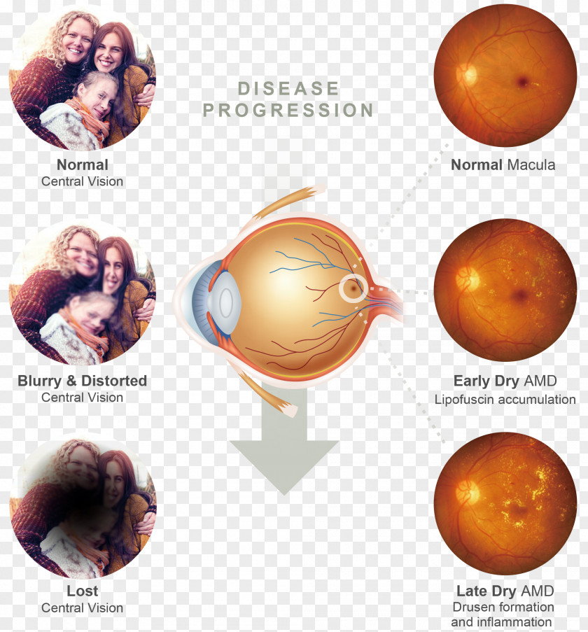 Eye Macular Degeneration Macula Of Retina Stargardt Disease PNG