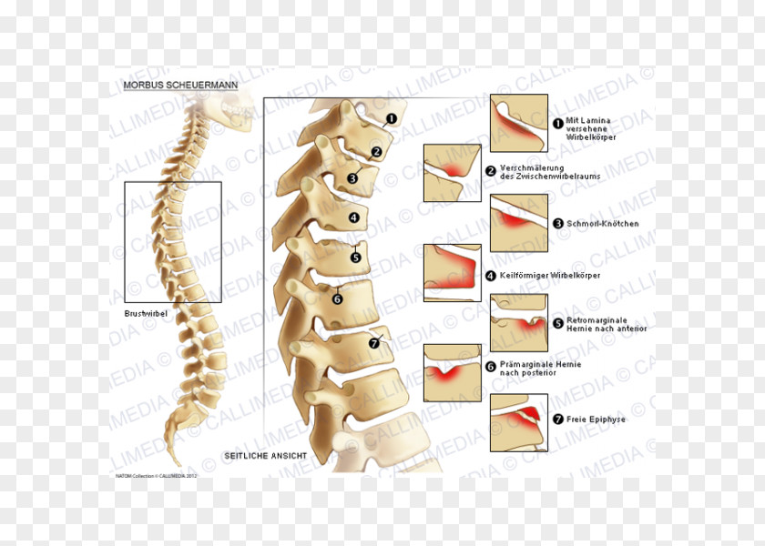 Realistic Schmorl's Nodes Scheuermann's Disease Hernia Pathology PNG