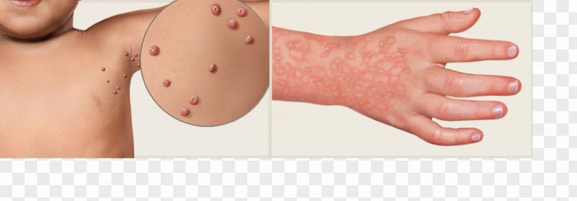 Child Exanthem Skin Rash Virus Morbilliform Fifth Disease PNG