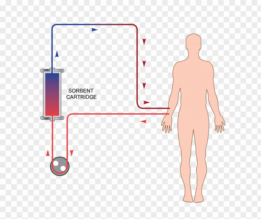 Separated Plasmapheresis LDL Apheresis Blood Plasma PNG