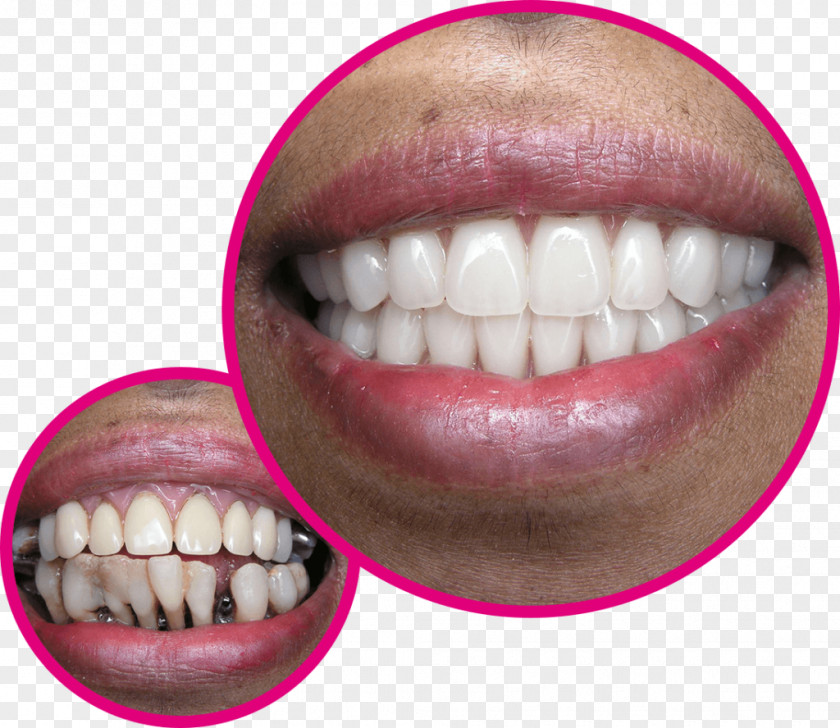 Kiesq Praktijk Voor Tandheelkunde Tooth Gebiss Dentist Dentures Implant PNG