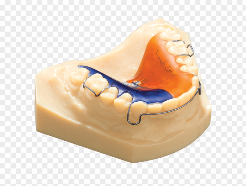3d Dental Treatment For Toothache Dentistry Stratasys 3D Printing Objet Geometries PNG