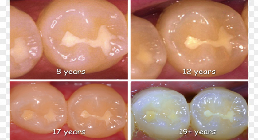 Tooth Decay Lesion Dental Sealant PNG