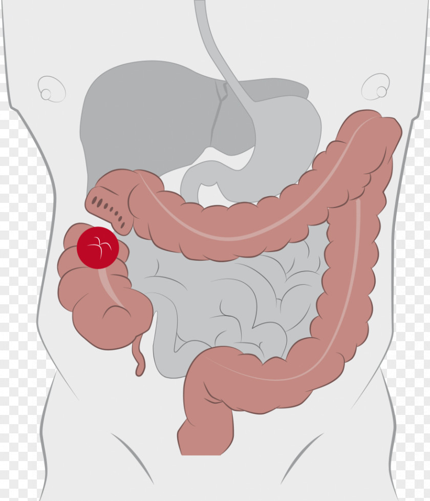 Bowel Colostomy Ileostomy Ostomy Pouching System Stoma Ileo-anal Pouch PNG