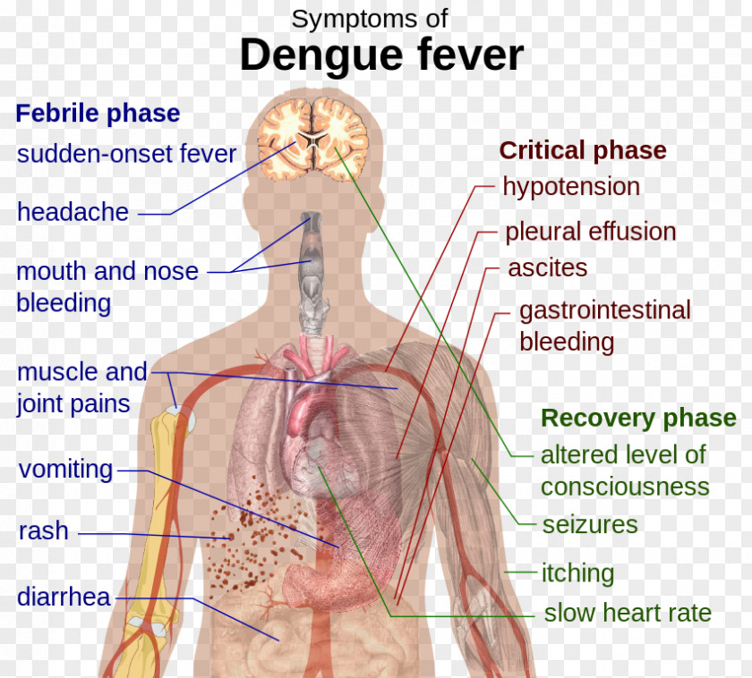 Mosquito Dengue Fever Scarlet Disease Complication PNG