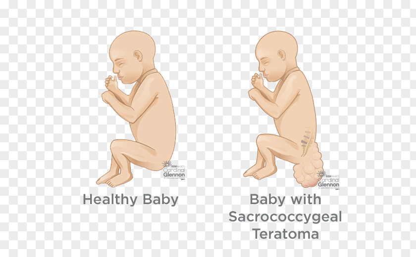 Diagnosis And Treatment Sacrococcygeal Teratoma Spina Bifida Birth Defect Surgery Vertebral Column PNG