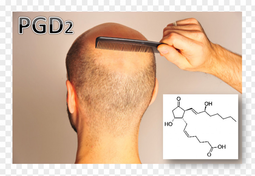 Hair Loss Prostaglandin D2 Scalp PNG