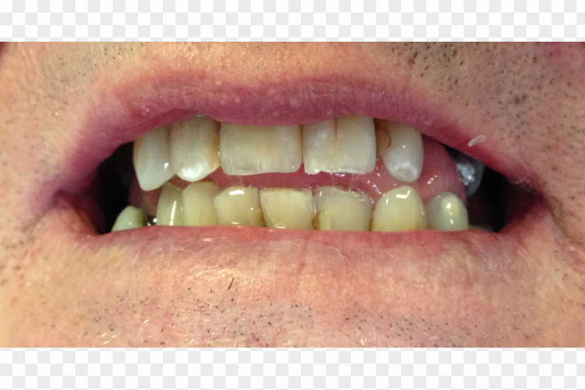 Orthodontics Surgery Close-up PNG