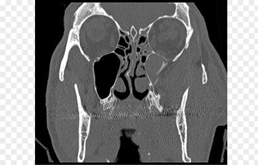 Bone Fracture Computed Tomography Lääketieteellinen Röntgenkuvaus X-ray Radiography PNG