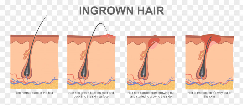 Hairs Ingrown Hair Removal Electrolysis Waxing PNG