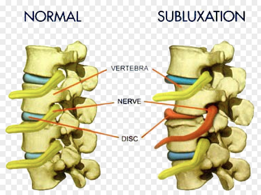 Health Vertebral Subluxation Chiropractic Column Pain PNG