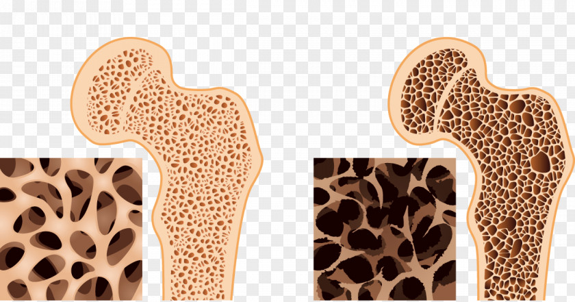 Health Bone Density Osteoporosis Osteopenia PNG