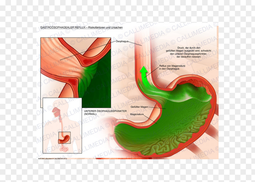 Esophagus Gastroesophageal Reflux Disease Gastroenterology Gastroenteritis Pathology PNG