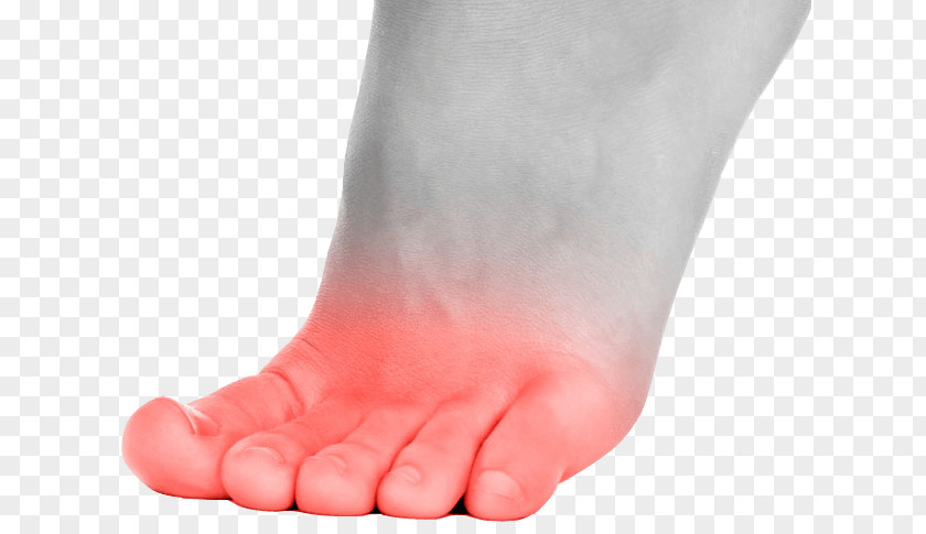 Gout Foot Problems Toe Ball Callus Disease PNG