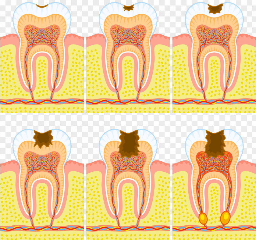 Tooth Decay Dentistry Pulp Human Dental Abscess PNG