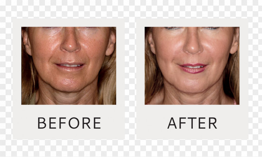 Face Cheek Mesotherapy Rhytidectomy Skin PNG