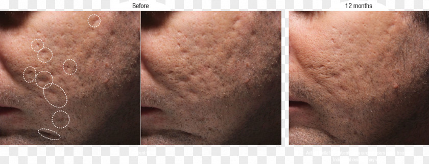 Acne Scars Scar Injectable Filler Botulinum Toxin Wrinkle PNG