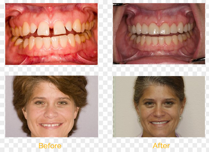Orlando Cheek MouthOrange Dentist Universal Smiles Dentistry PNG