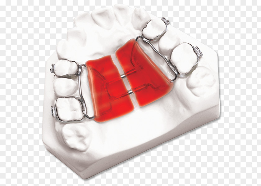 Palatal Expansion DynaFlex Orthodontics Orthodontic Technology Maxilla PNG