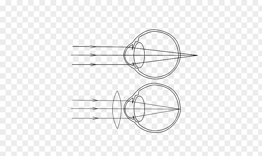 Eye Far-sightedness Near-sightedness Contact Lenses Astigmatism PNG