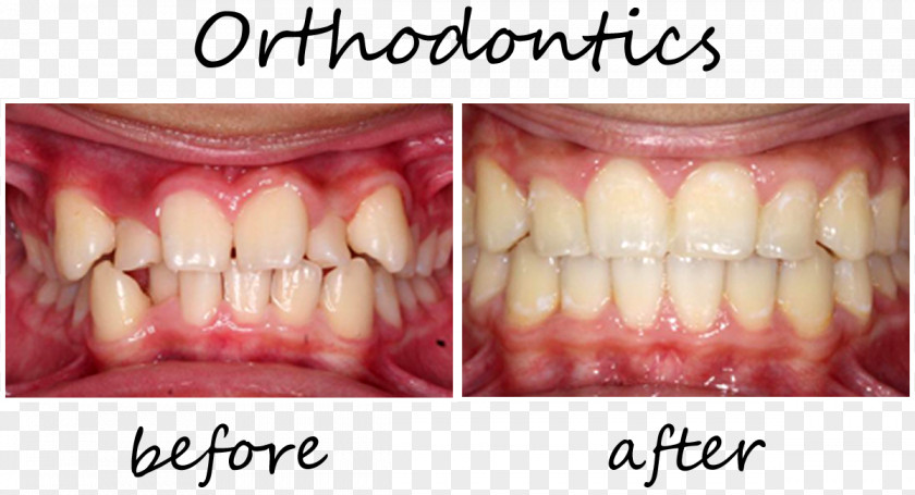 Crown Tooth Orthodontics Cosmetic Dentistry Dental Braces PNG