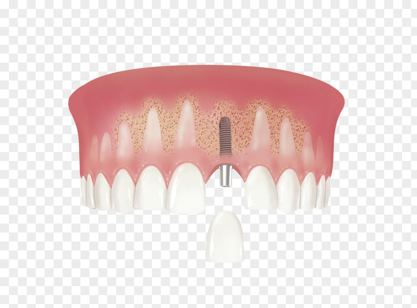 Crown Human Tooth Dental Implant Implantology PNG