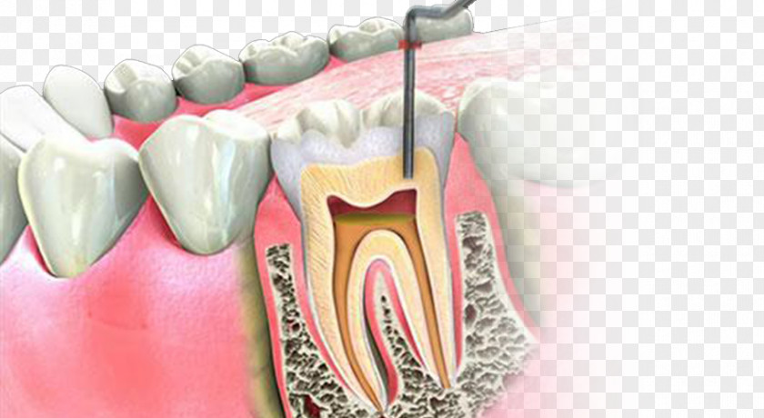 Root Canal Endodontic Therapy Endodontics Dentistry PNG
