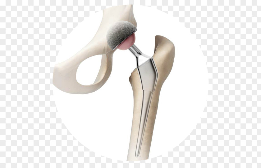 Artrosis De Rodilla Hip Replacement Prosthesis Knee PNG