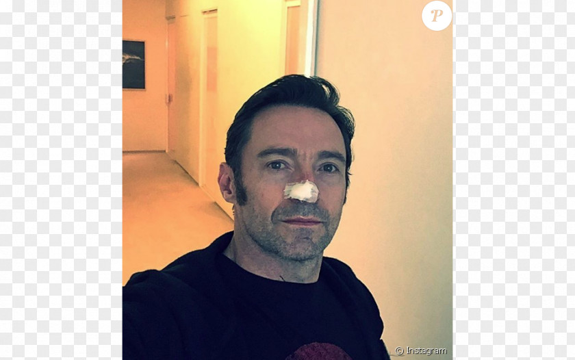 Hugh Jackman Skin Cancer Nose Surgery PNG