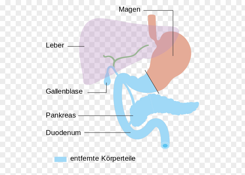 Diagramm Pancreaticoduodenectomy Pancreatic Cancer Pancreas Thumb Surgery PNG