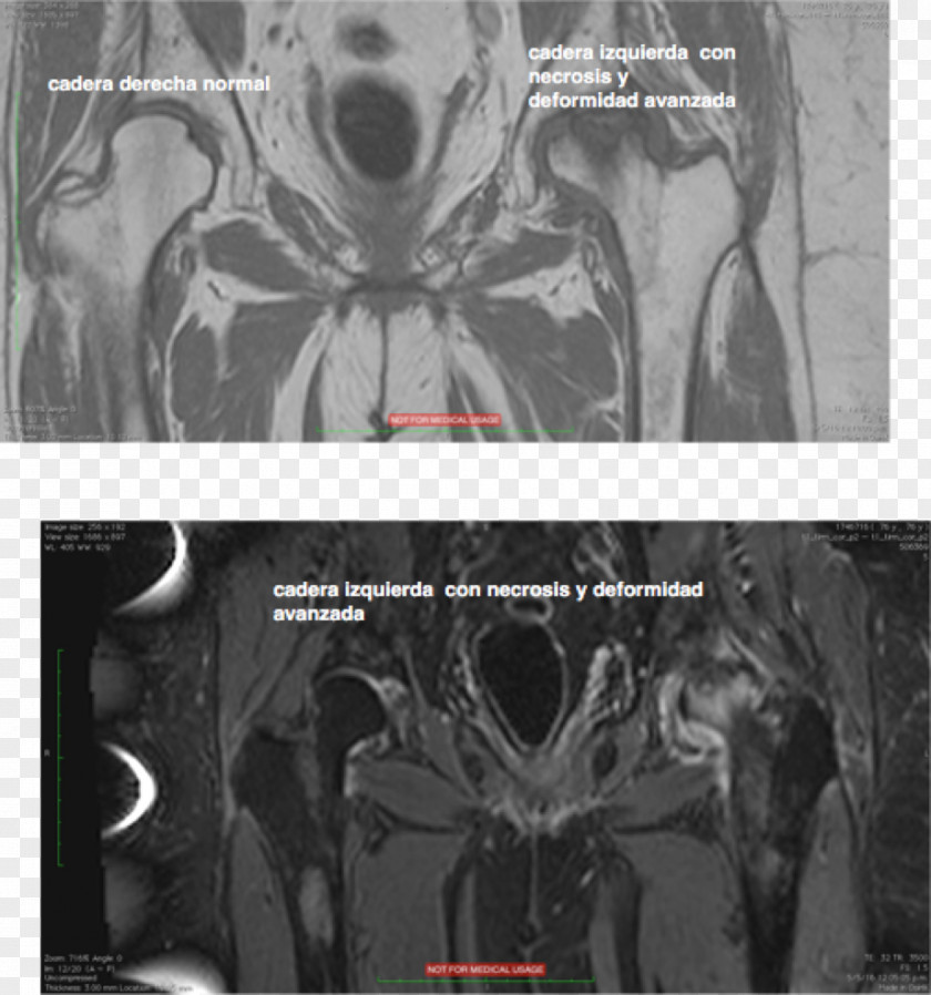 Vascular Bone Infarction Computed Tomography Femoral Head Femur Legg–Calvé–Perthes Disease PNG