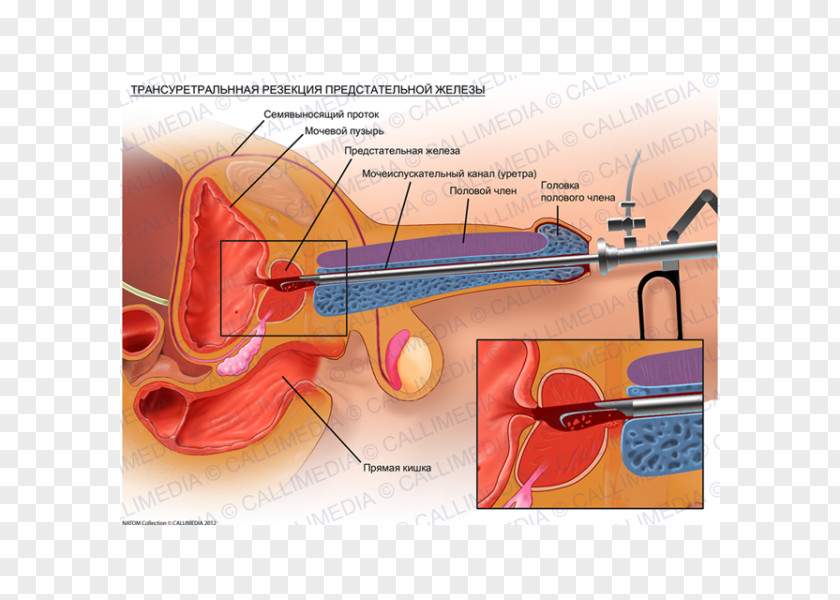 Transurethral Resection Of The Prostate Cancer Benign Prostatic Hyperplasia Surgery PNG