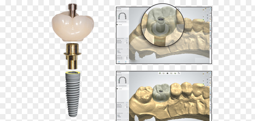Crown Dental Implant Temporary Screw PNG