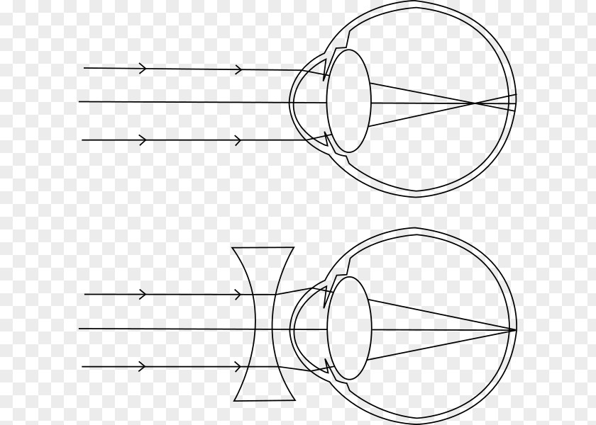 Myopia Near-sightedness Hypermetropia Eye Presbyopia Visual Perception PNG