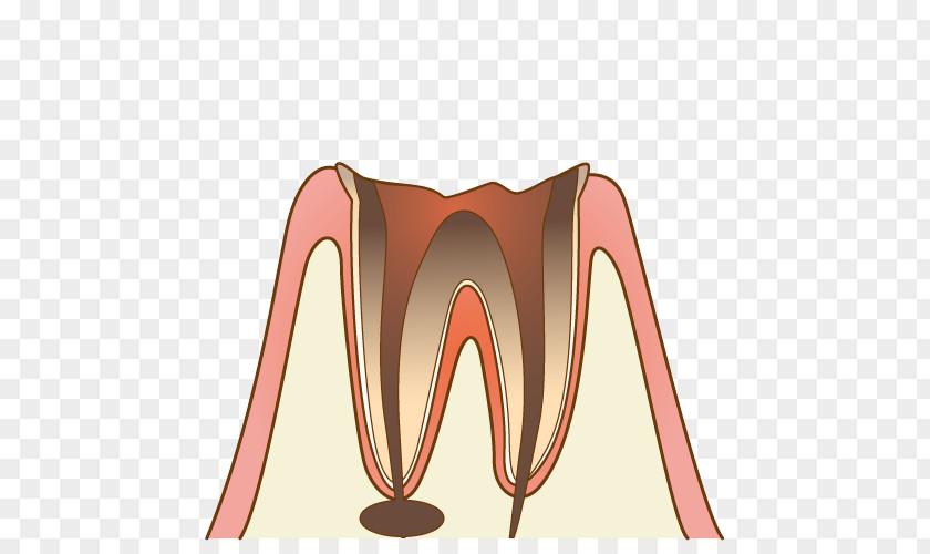 Cavity 歯科 Dentist Therapy Tooth Decay 診療 PNG