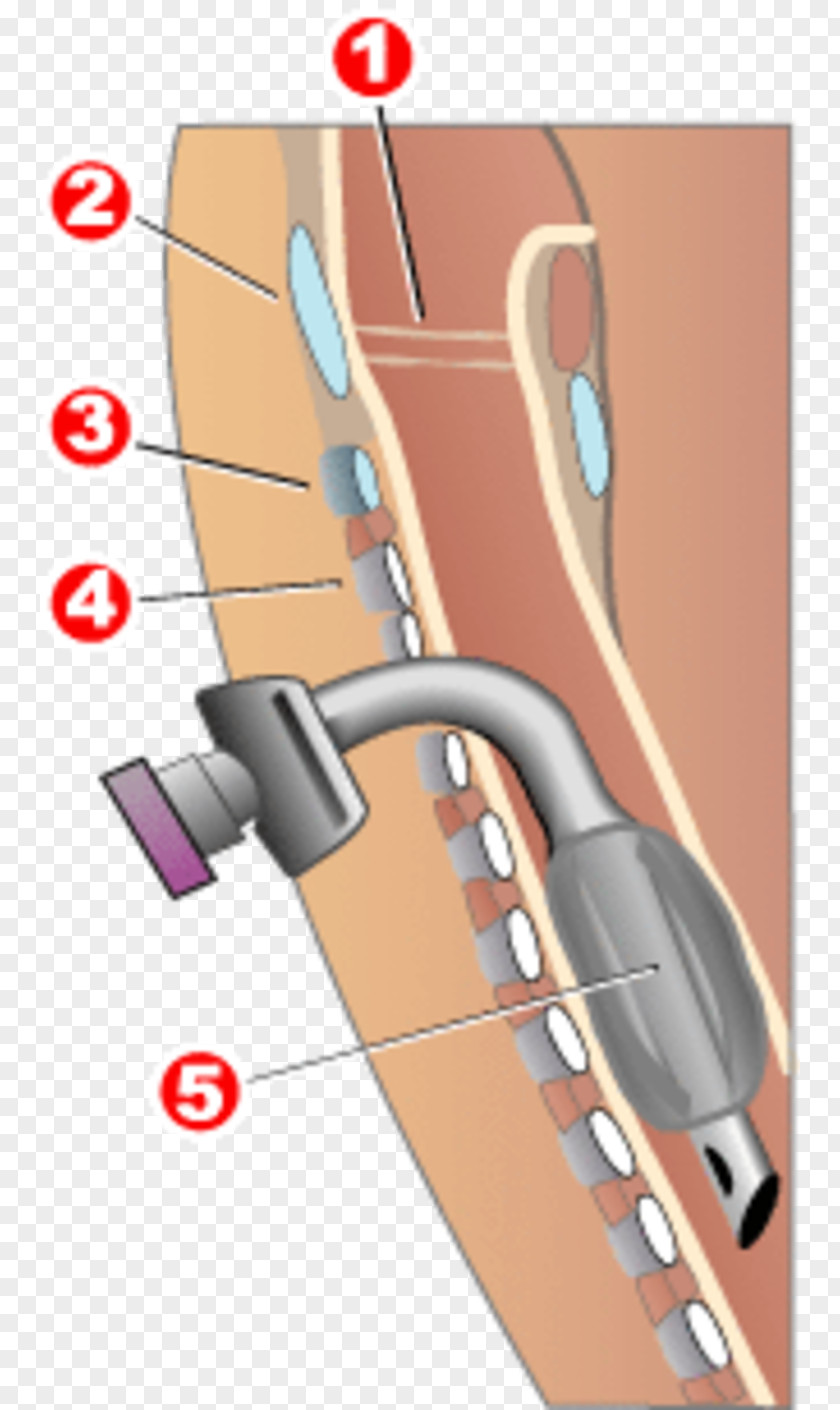 Tracheotomy Tracheal Tube Thyroid Cartilage Cricoid PNG